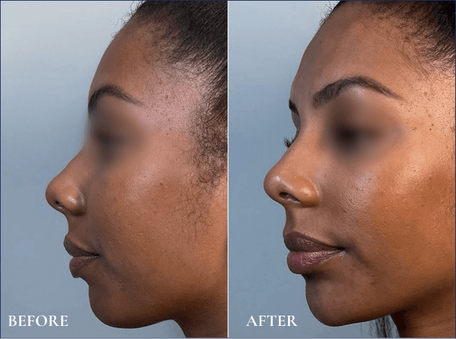 chin-fillers-before-after-2.png