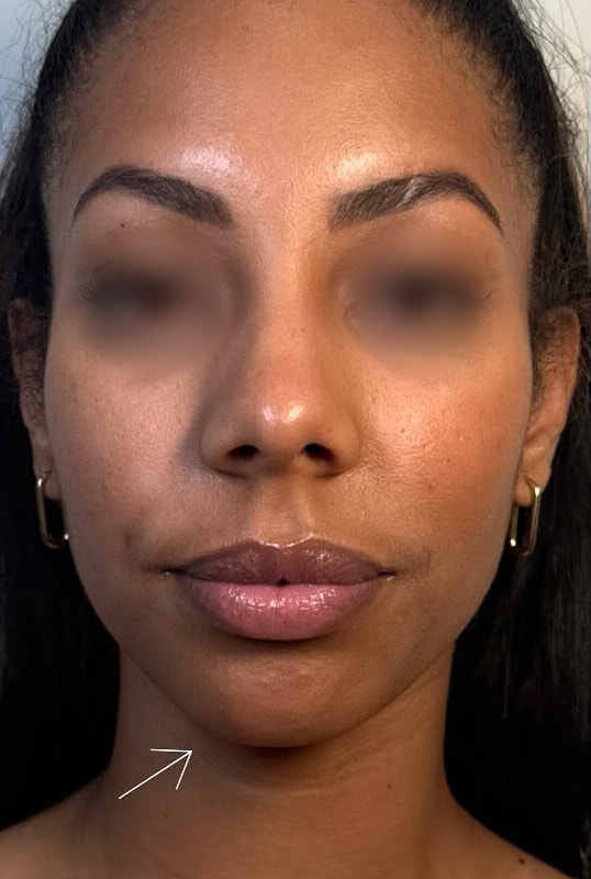 Chin Fillers Before & After Image