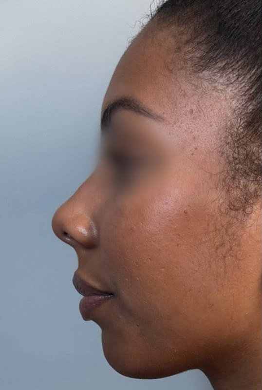 Chin Fillers Before & After Image