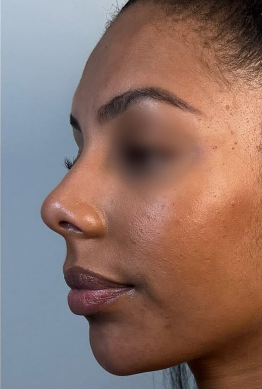 Chin Fillers Before & After Image