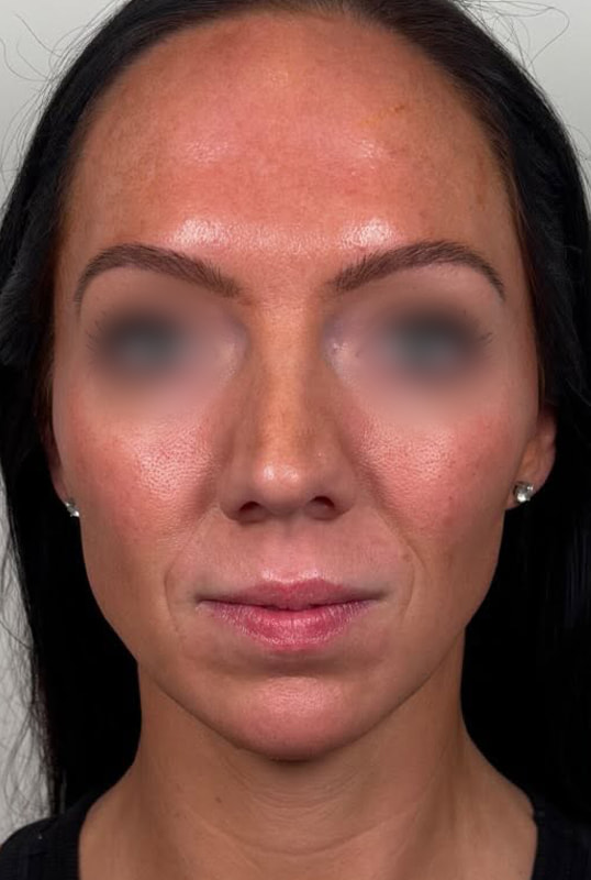 Chin and Jaw Fillers Before & After Image