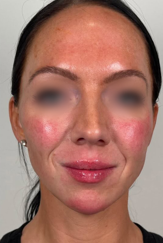 Chin and Jaw Fillers Before & After Image