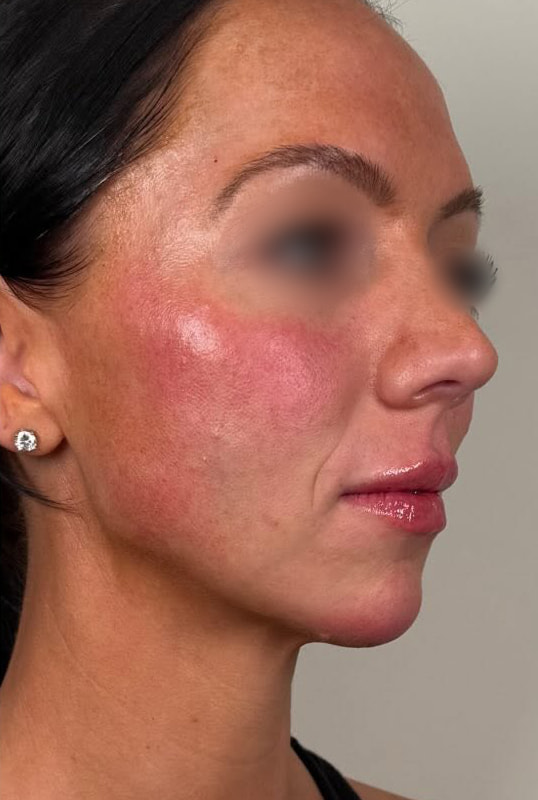 Chin and Jaw Fillers Before & After Image