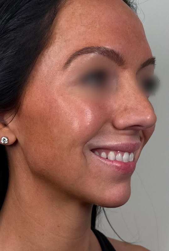 Chin and Jaw Fillers Before & After Image