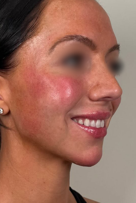 Chin and Jaw Fillers Before & After Image