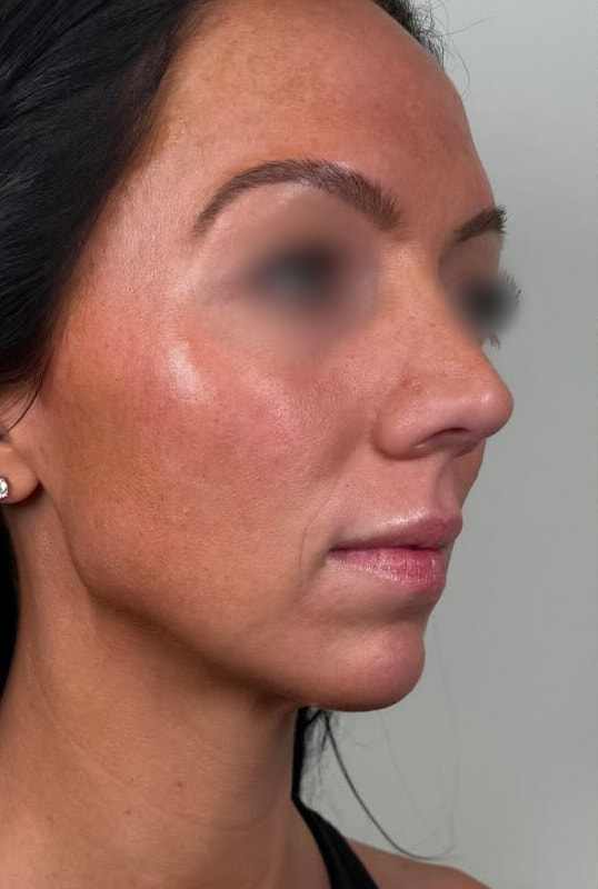 Chin and Jaw Fillers Before & After