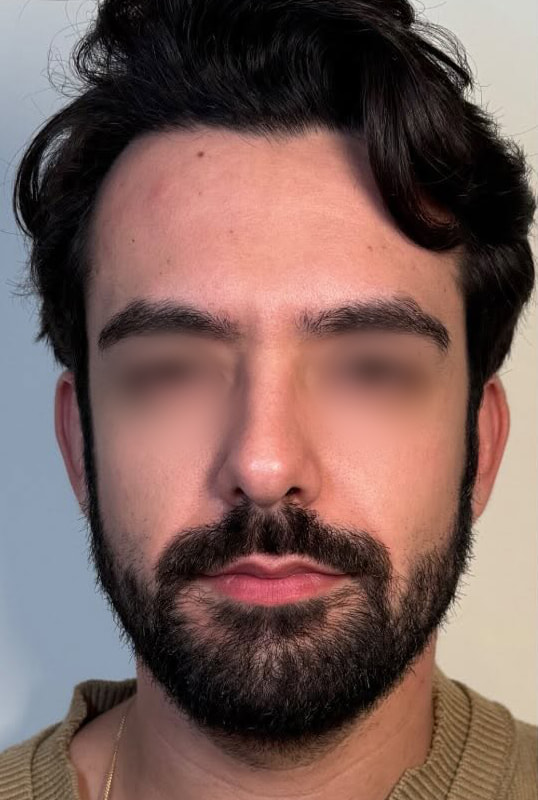Full Face Rebalancing Before & After Image