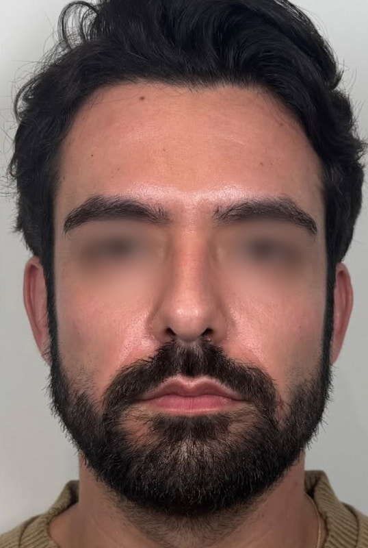 Full Face Rebalancing Before & After Image