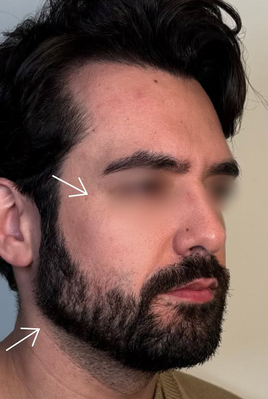 Full Face Rebalancing Before & After Image