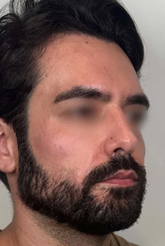 Full Face Rebalancing Before & After Image