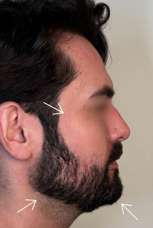 Full Face Rebalancing Before & After Image