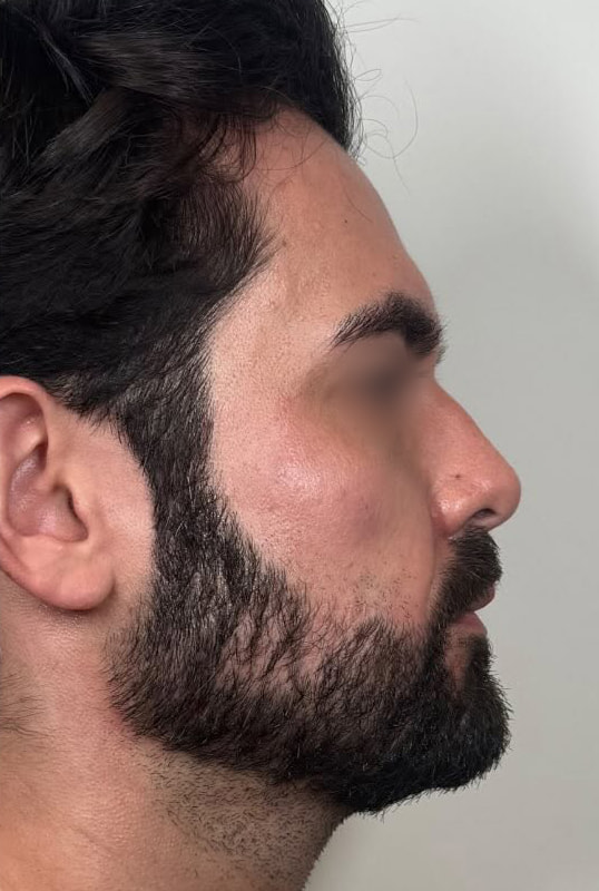 Full Face Rebalancing Before & After