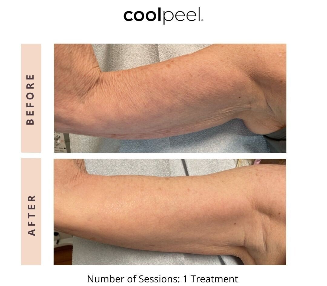 Laser Skin Resurfacing Before & After