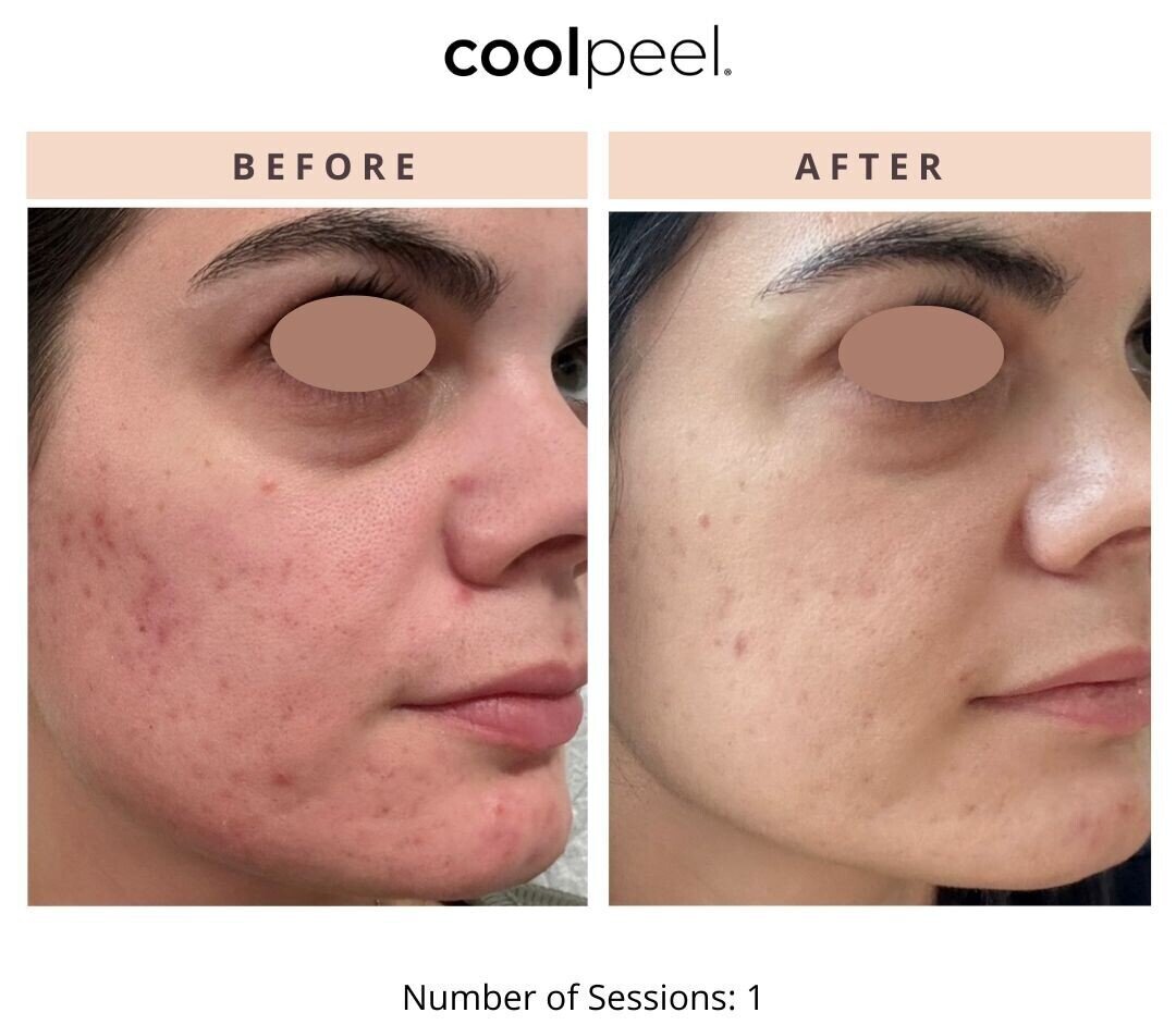 Laser Skin Resurfacing Before & After