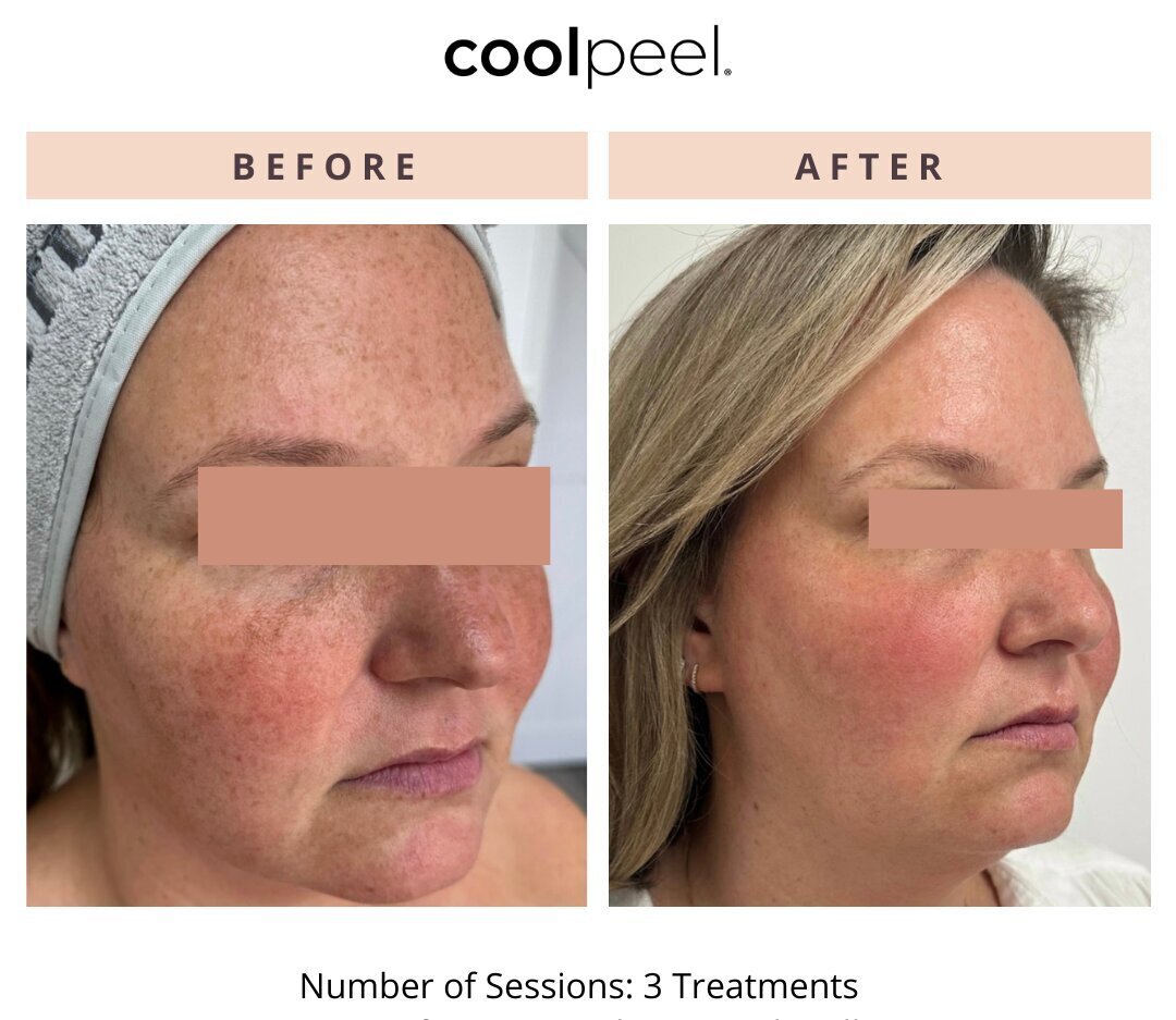 Laser Skin Resurfacing Before & After