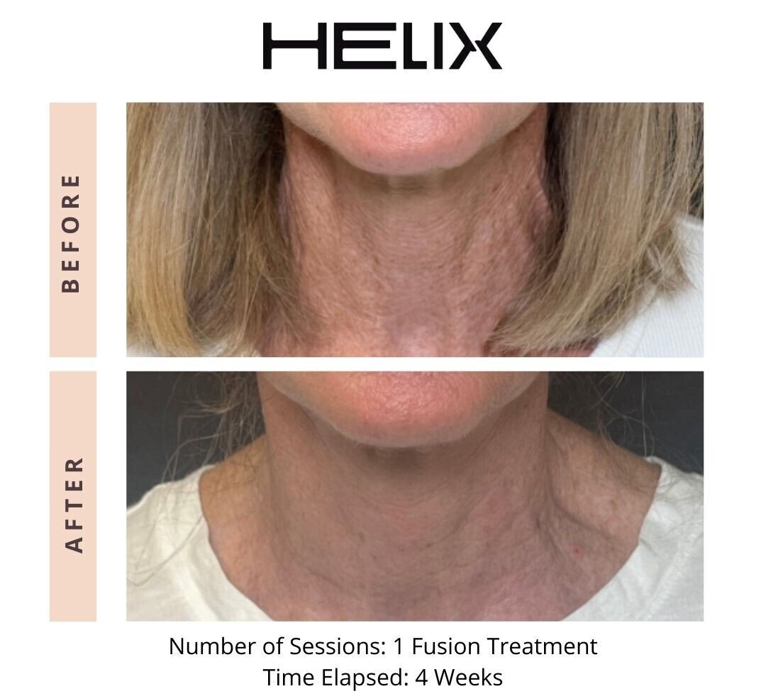 Laser Skin Resurfacing Before & After