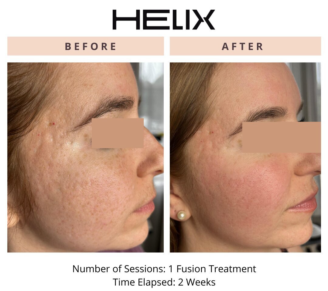Laser Skin Resurfacing Before & After