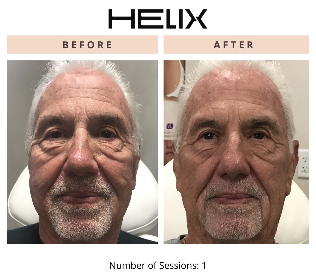 Laser Skin Resurfacing Before & After