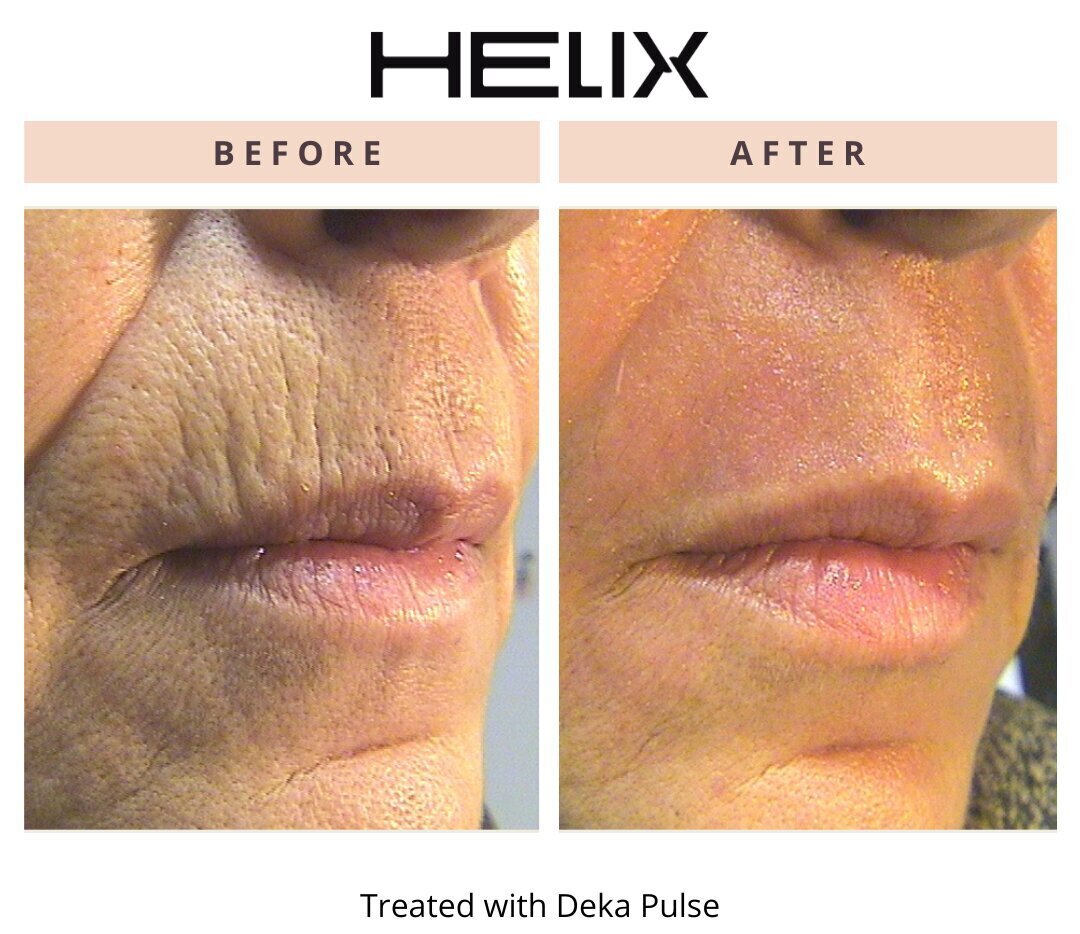 Laser Skin Resurfacing Before & After