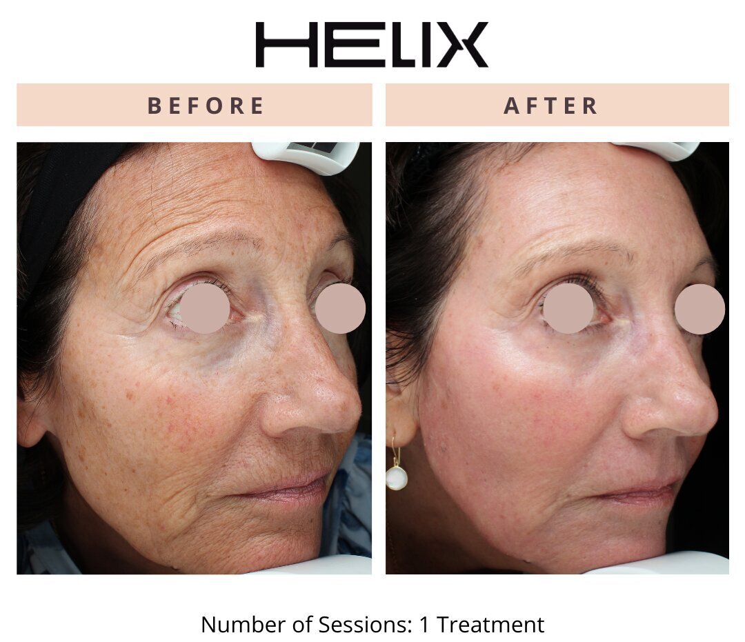 Laser Skin Resurfacing Before & After