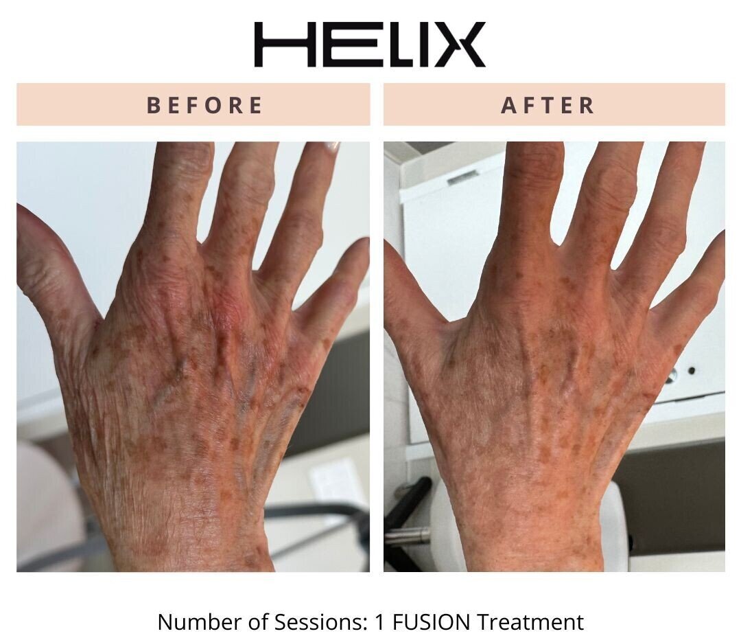 Laser Skin Resurfacing Before & After