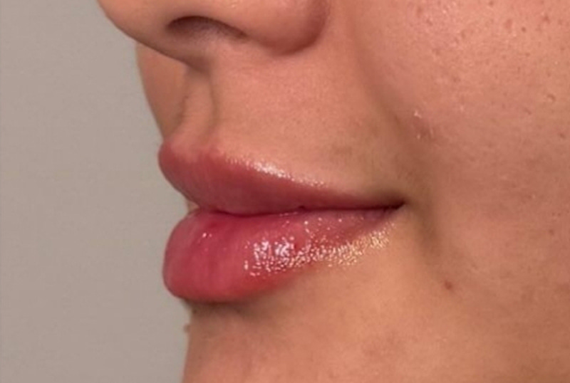 Lip Fillers Before & After Image