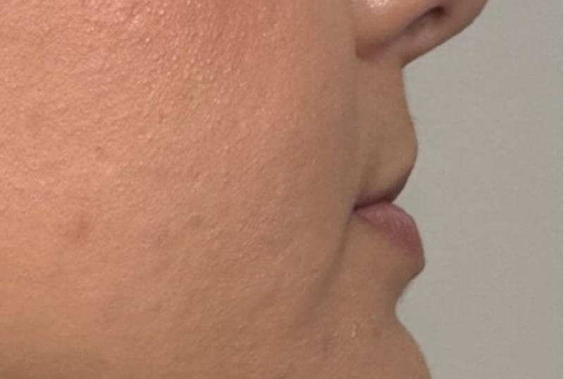 Lip Fillers Before & After Image