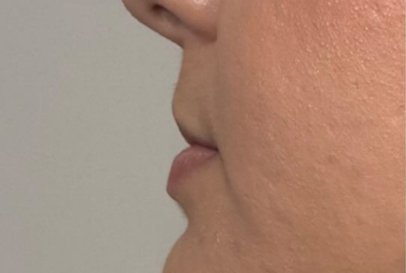 Lip Fillers Before & After Image