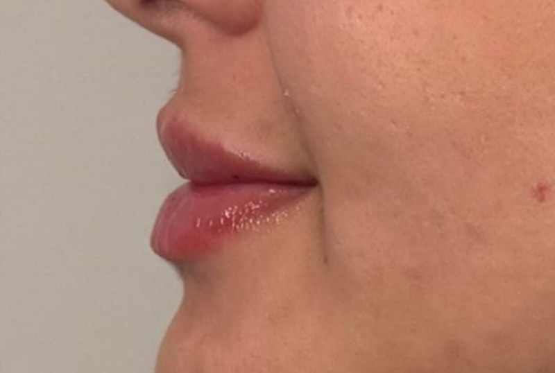 Lip Fillers Before & After Image