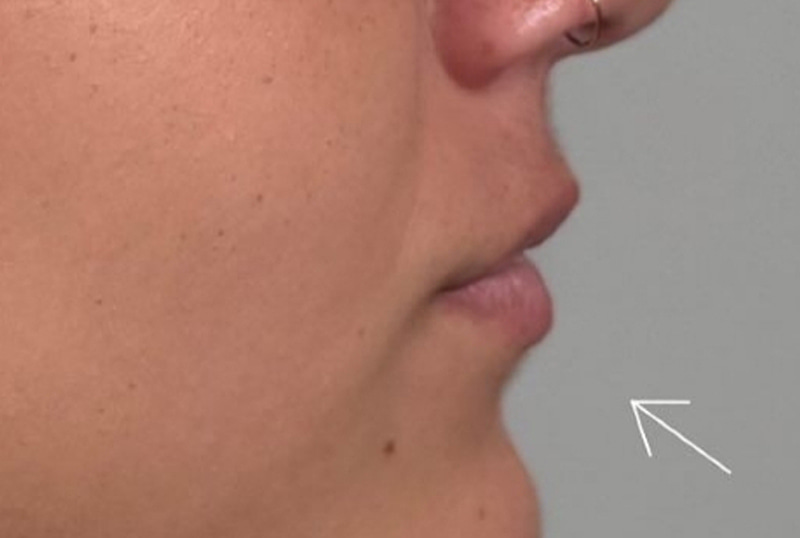 Lip Fillers Before & After Image