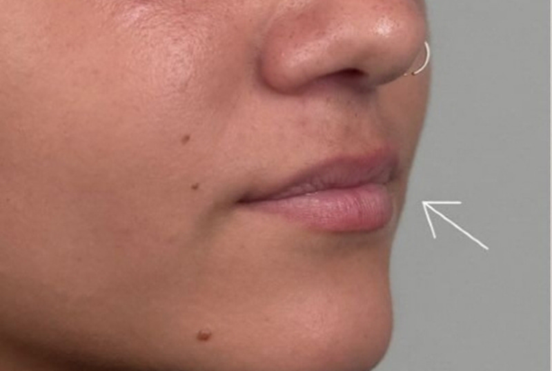 Lip Fillers Before & After Image