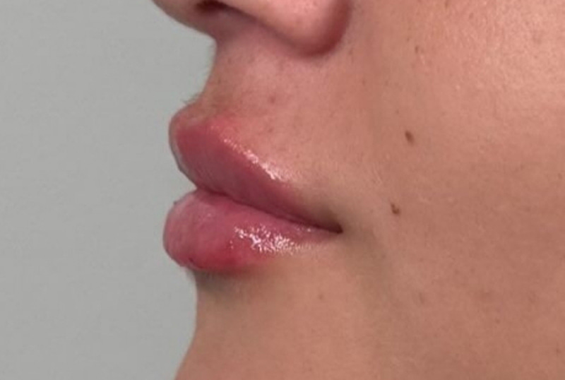 Lip Fillers Before & After