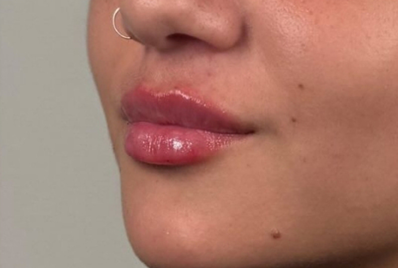 Lip Fillers Before & After