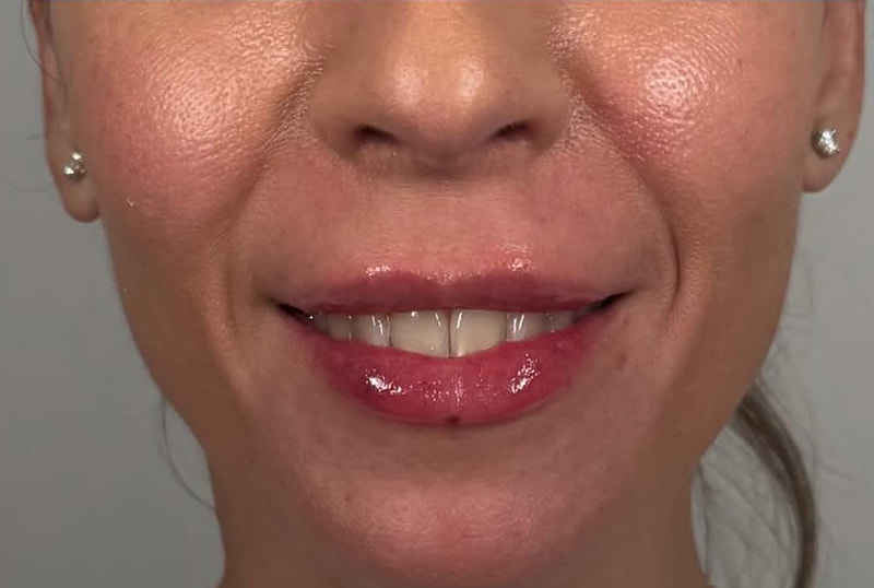 Lip Fillers Before & After Image