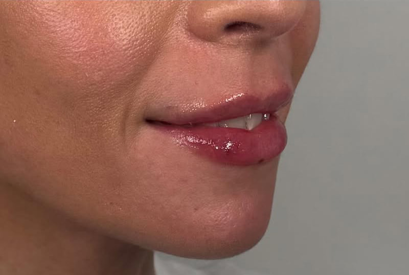 Lip Fillers Before & After Image