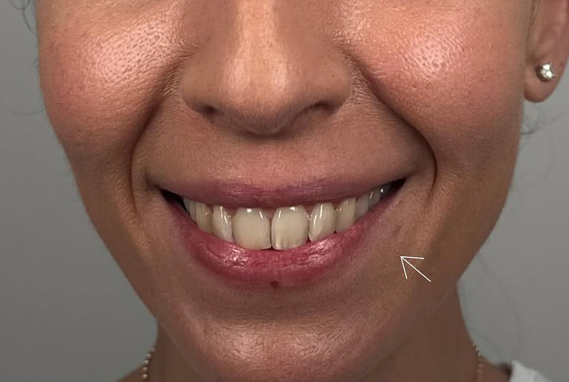 Lip Fillers Before & After