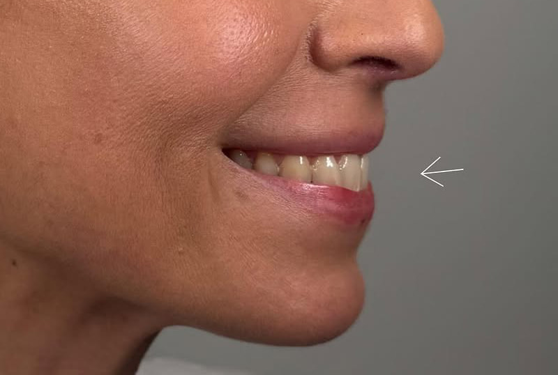 Lip Fillers Before & After