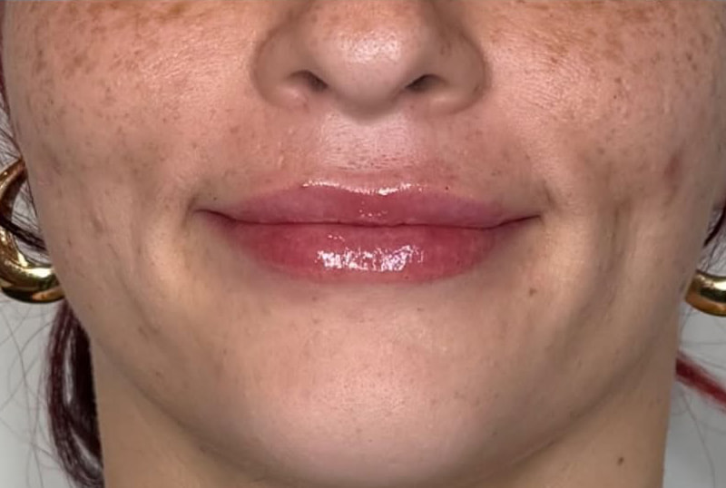 Lip Fillers Before & After Image
