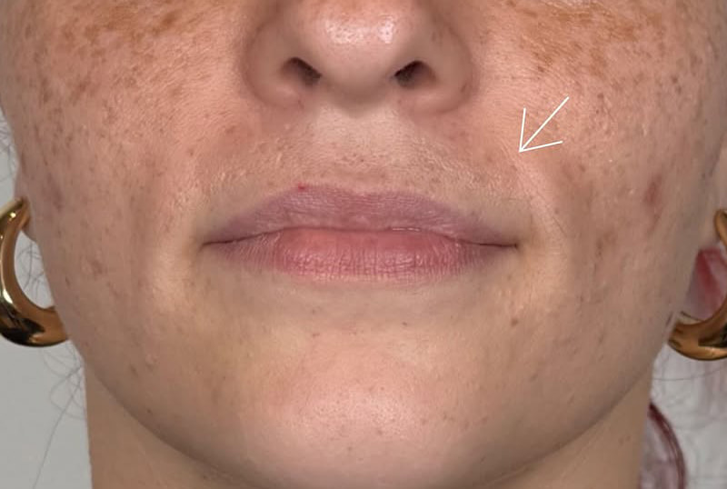 Lip Fillers Before & After
