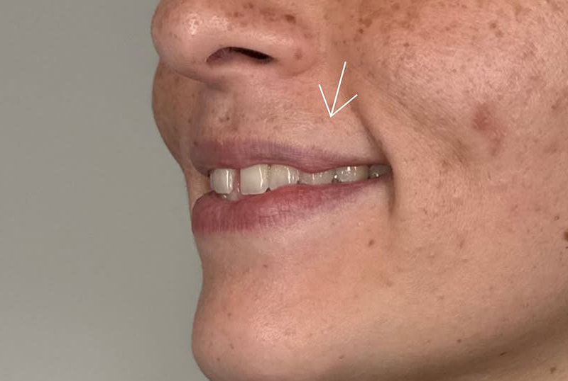 Lip Fillers Before & After