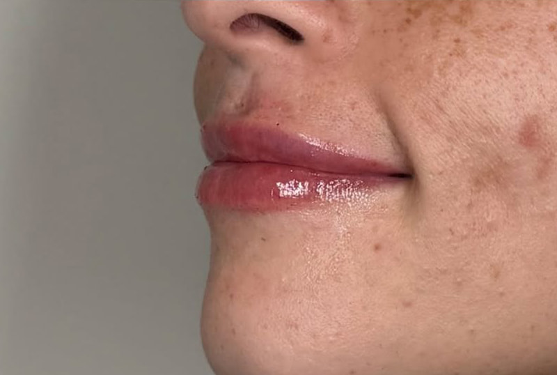 Lip Fillers Before & After
