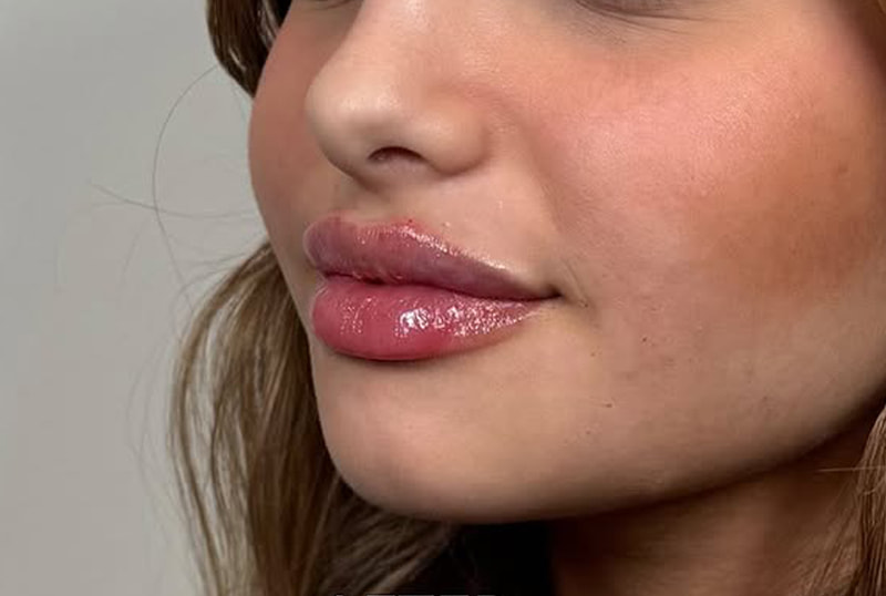 Lip Fillers Before & After Image