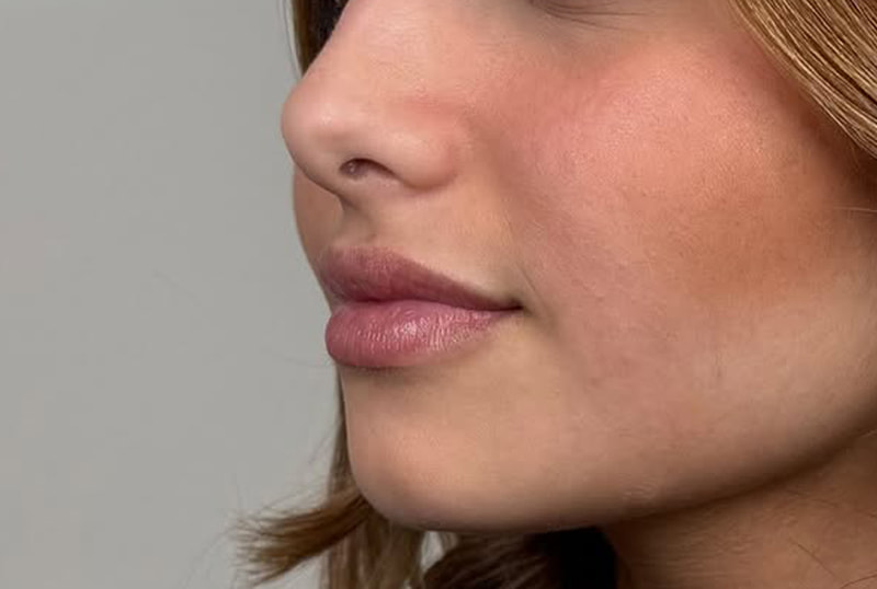 Lip Fillers Before & After