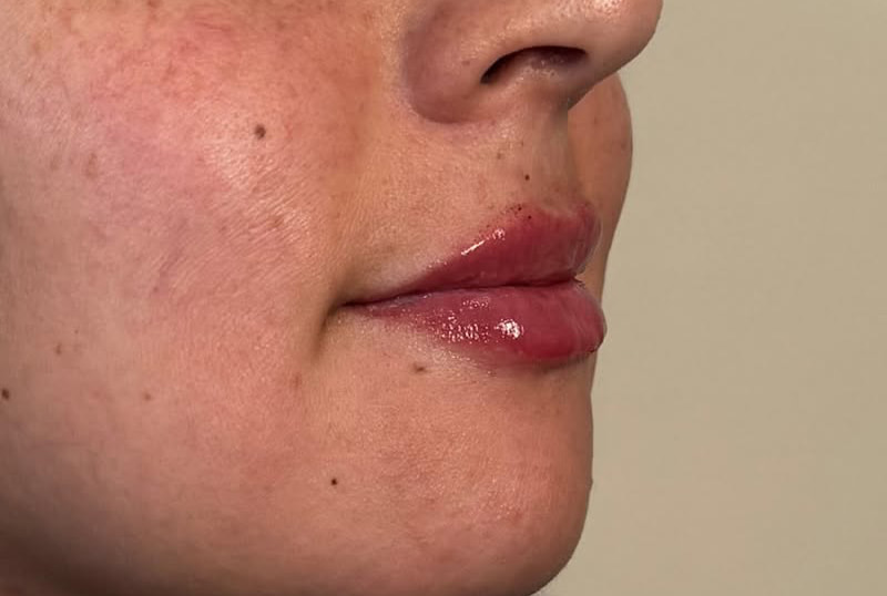 Lip Fillers Before & After Image