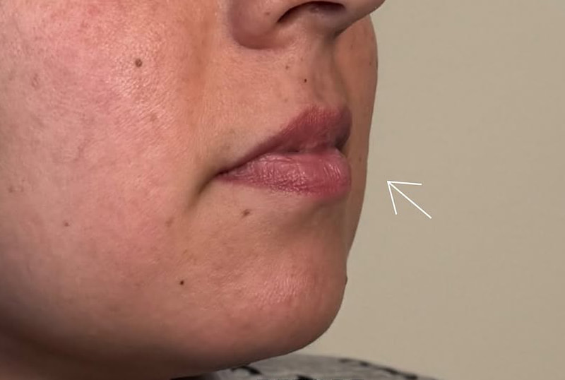 Lip Fillers Before & After Image