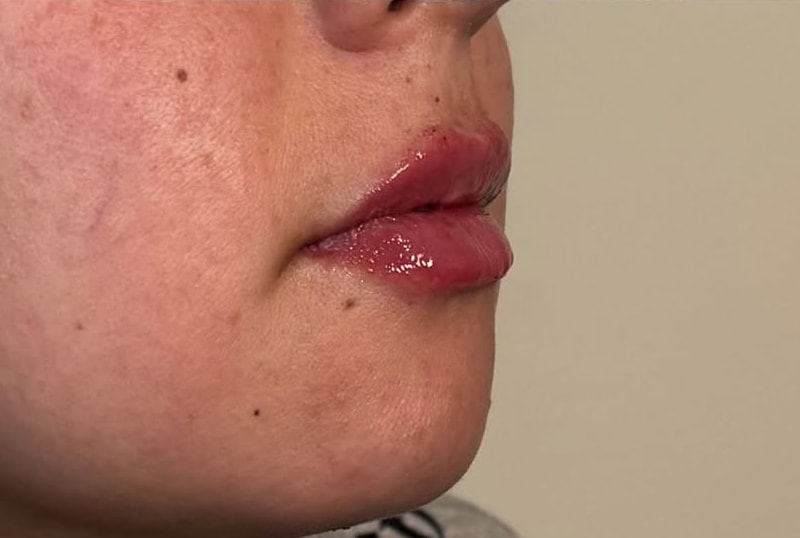 Lip Fillers Before & After Image