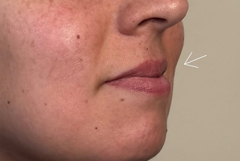 Lip Fillers Before & After