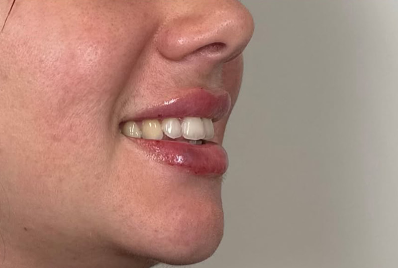 Lip Fillers Before & After Image
