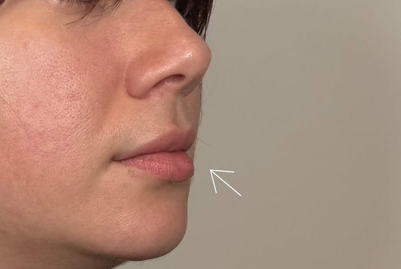 Lip Fillers Before & After Image
