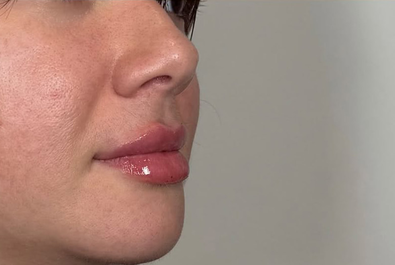 Lip Fillers Before & After Image
